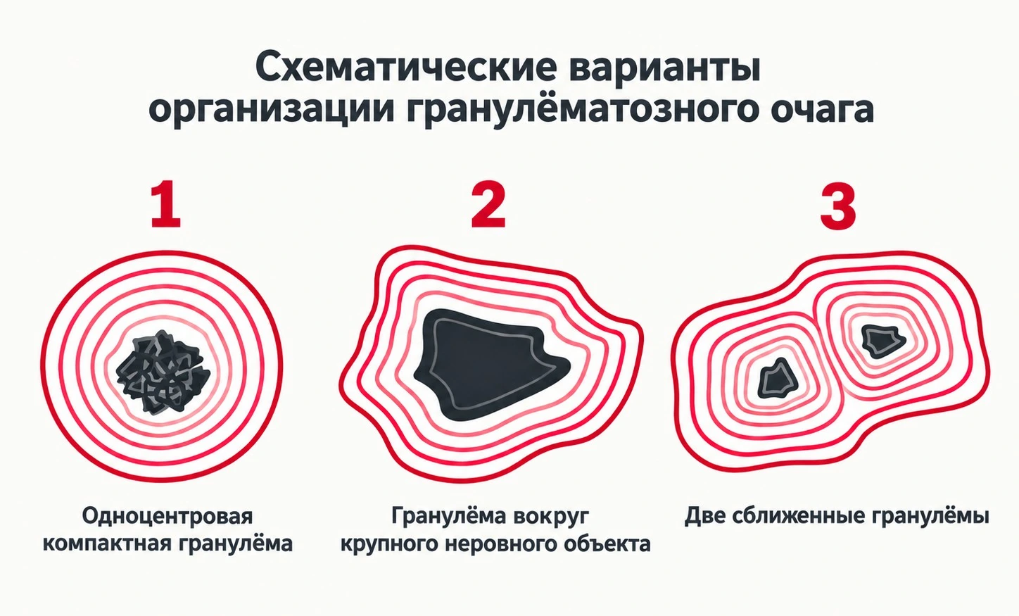 Factors influencing granuloma shape