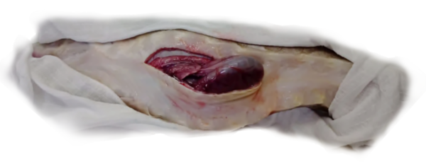 Removing foreign bodies