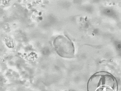 Trichomonas