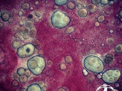 Granulomas with mycobacteria (Mycobacterium)