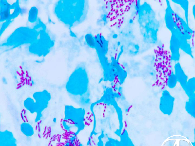 Mycobacteria - Ziehl's stain