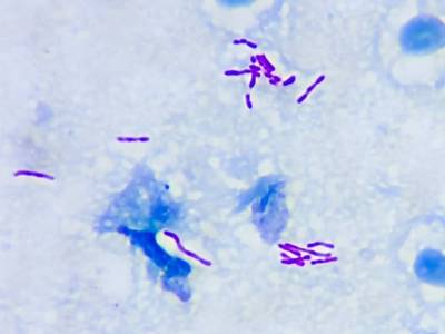Mycobacteria - Ziehl's stain