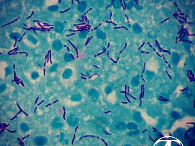 Mycobacteria. Ziehl's stain