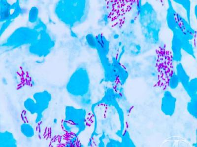 Mycobacteria - Ziehl's stain