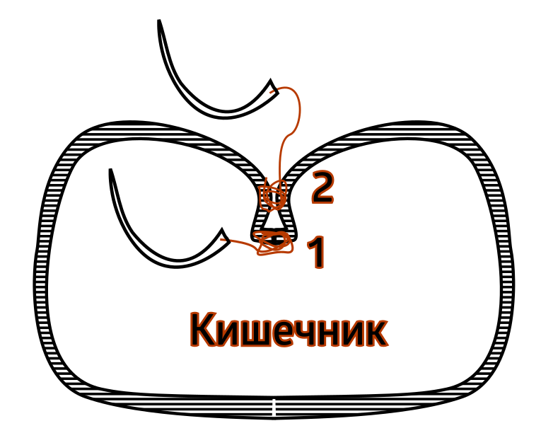 Инвагинирующий шов